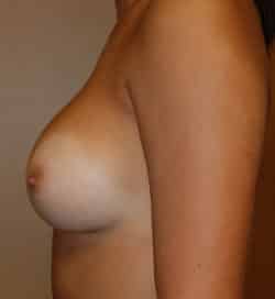 Breast Augmentation