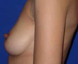 Breast Augmentation