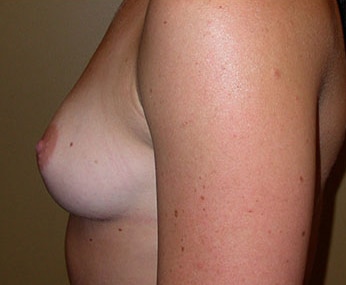 Breast Augmentation