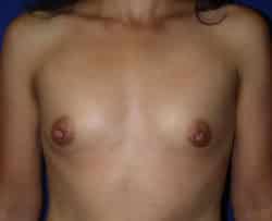 Breast Augmentation