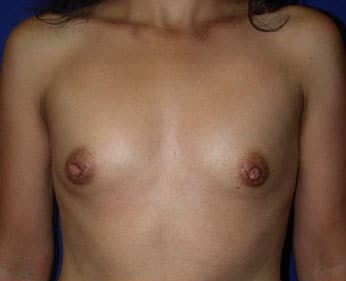 Breast Augmentation