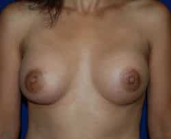 Breast Augmentation