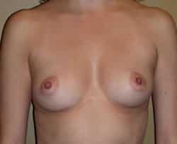 Breast Augmentation