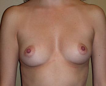 Breast Augmentation