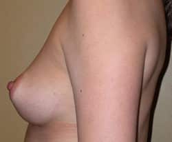 Breast Augmentation