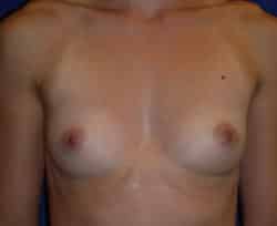 Breast Augmentation