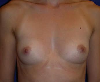 Breast Augmentation