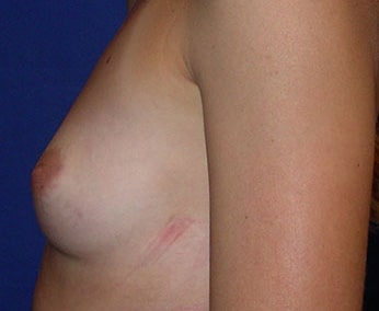 Breast Augmentation