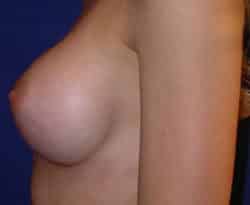 Breast Augmentation