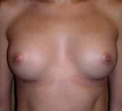 Breast Augmentation