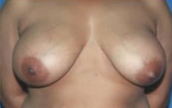 male breast reduction