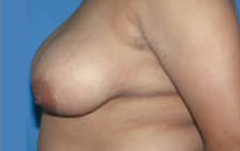 Breast Reduction