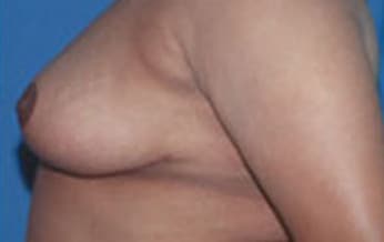 Breast Reduction