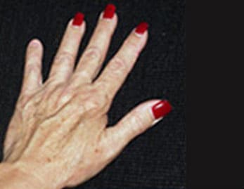 Hand Rejuvenation