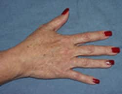 Hand Rejuvenation