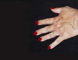 Hand Rejuvenation