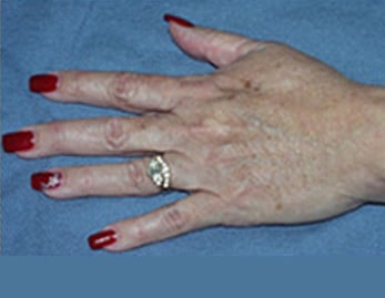 Hand Rejuvenation