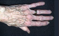 Hand Rejuvenation