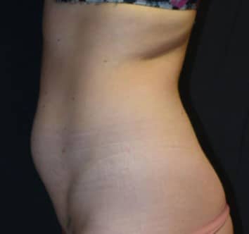 Liposuction