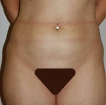 Liposuction