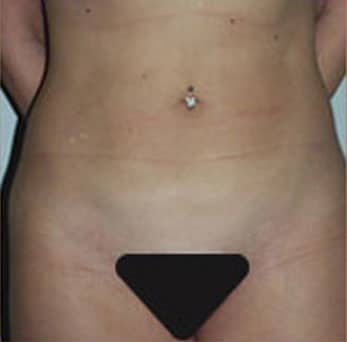 Liposuction