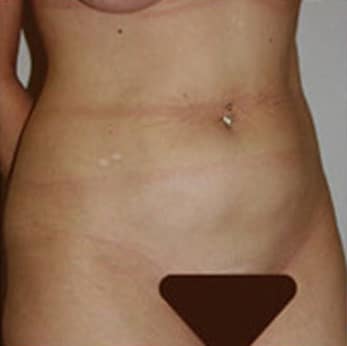 Liposuction