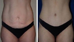 tummy tuck