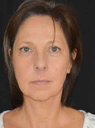 Facelift