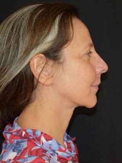 Facelift