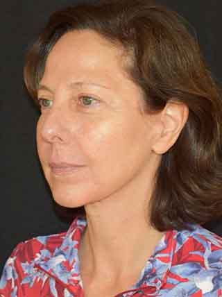 Facelift